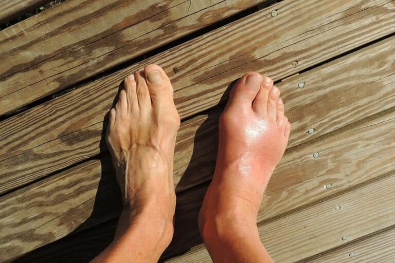 Does Seafood Cause Gout